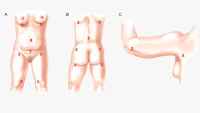 Incision points of a buttocks fat transfer augmentation surgery