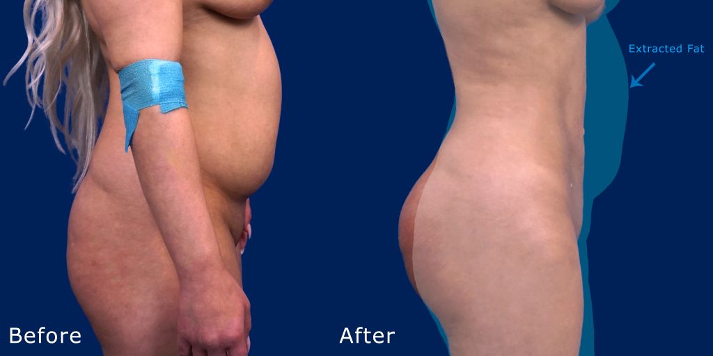 Fat transfer - 37 year old woman