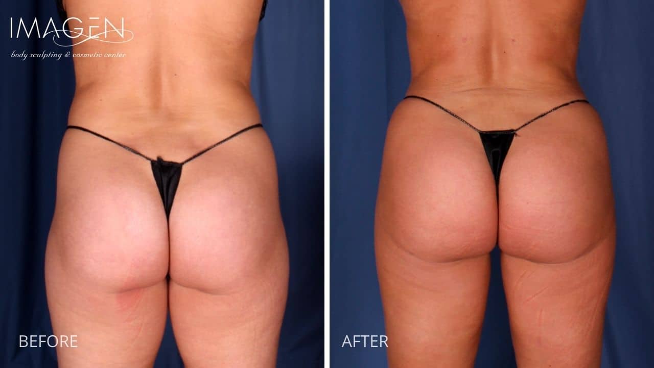 BBL Female Patient - Copyright Omaha Liposuction by Imagen