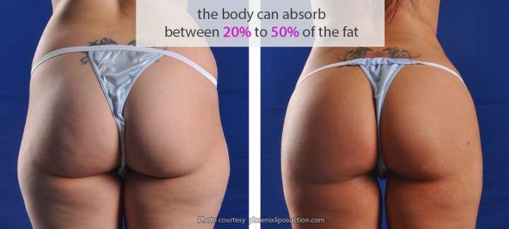 The body absorbs 20% to 50% of the fat during a bbl recovery