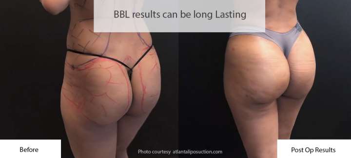 BBL Recovery, Brazilian Butt Lift Recovery Guide (updated 2022)