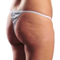 Before a Butt Lift - 33 year old woman
