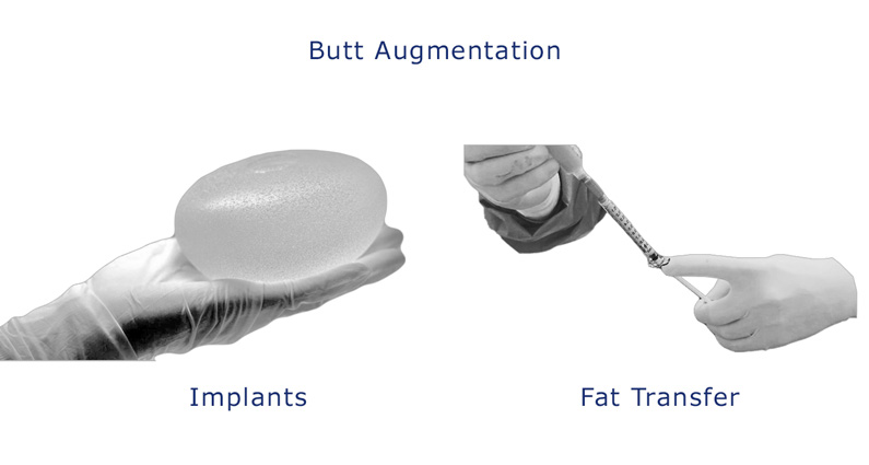 Patients have two surgical options of buttocks augmentation (Implants) or (Fat Transfer)