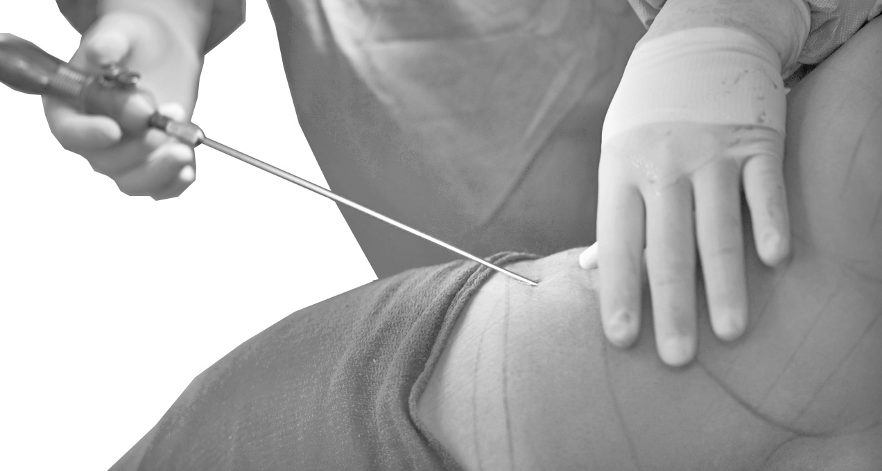 Surgeons perform liposuction to extract fat from donor areas