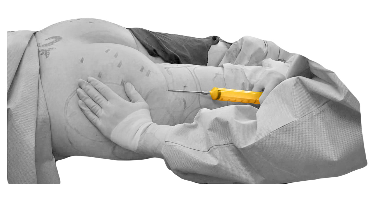 The purified fat cells are re-injected into the desired sections of the butt