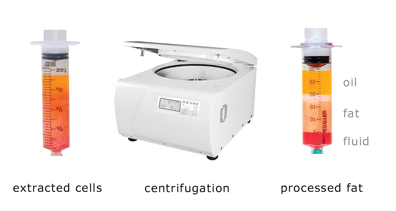 Fat processing to separate the usable fat cells