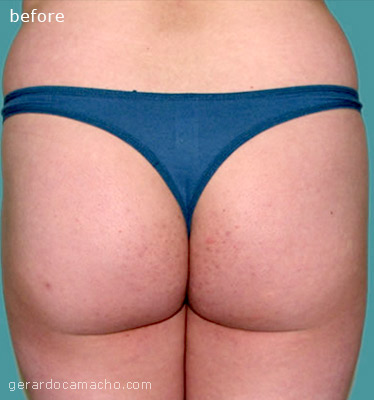 Before the procedure - 33 year old woman