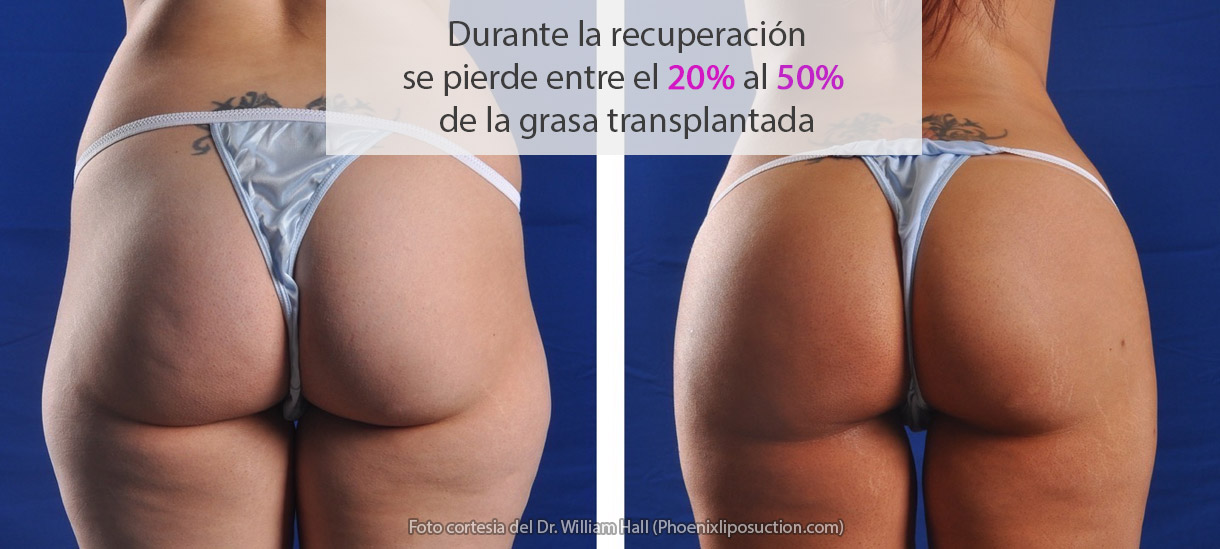 El cuerpo reabsorbe hasta el 50% de la grasa transferida