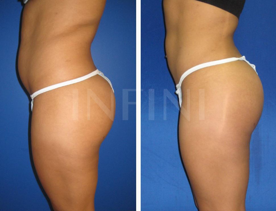 BBL Female Patient - Copyright Omaha Liposuction by Imagen