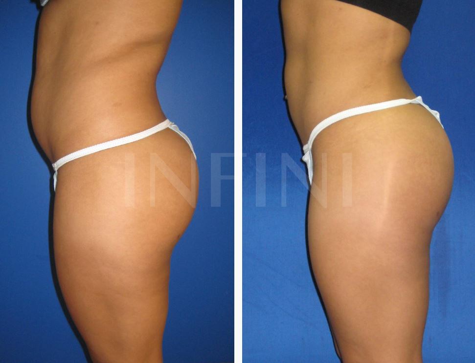 Brazilian Butt Lift (BBL) - Technique, Costs, Recovery, FAQS & BBL Surgeons