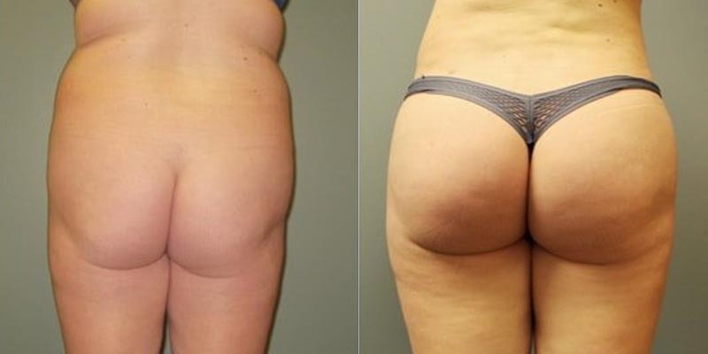 Dr. Roxanne Grawe bbl before and afters