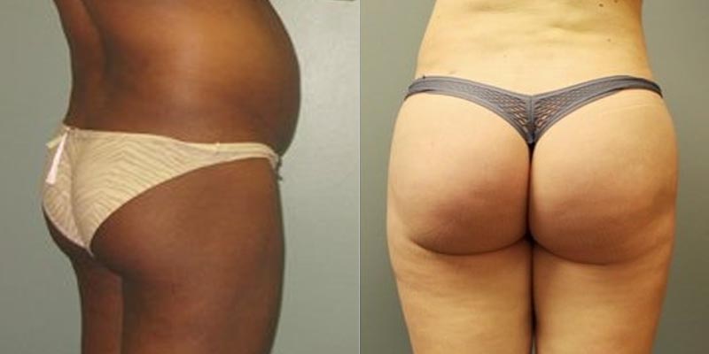 Dr. Roxanne Grawe bbl before and afters