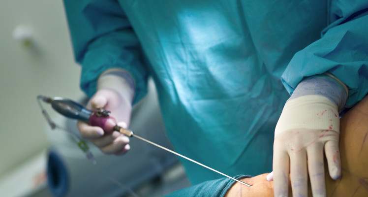 La grasa se extrae mediante liposucción.