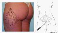 Liposuction - tunneling the fat in a cross-hatch from two incision points
