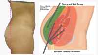 Safe Zones for cannula placement during a fat transfer to buttocks