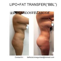 Bbl Before And After Pictures