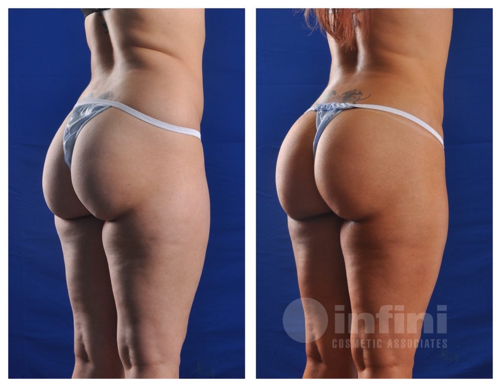 Brazillian Butt Implants 57