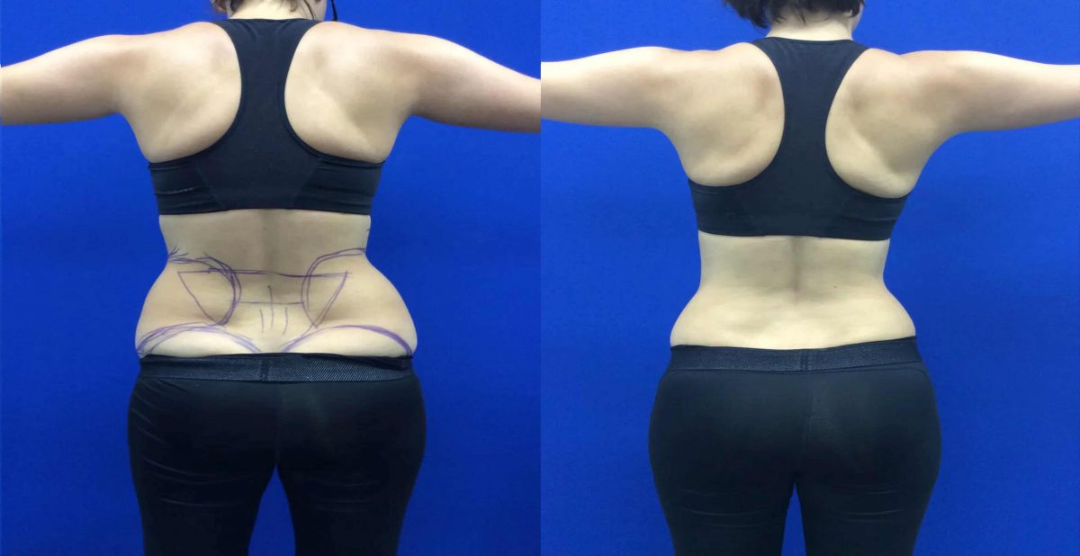 Liposuction to Liposculture