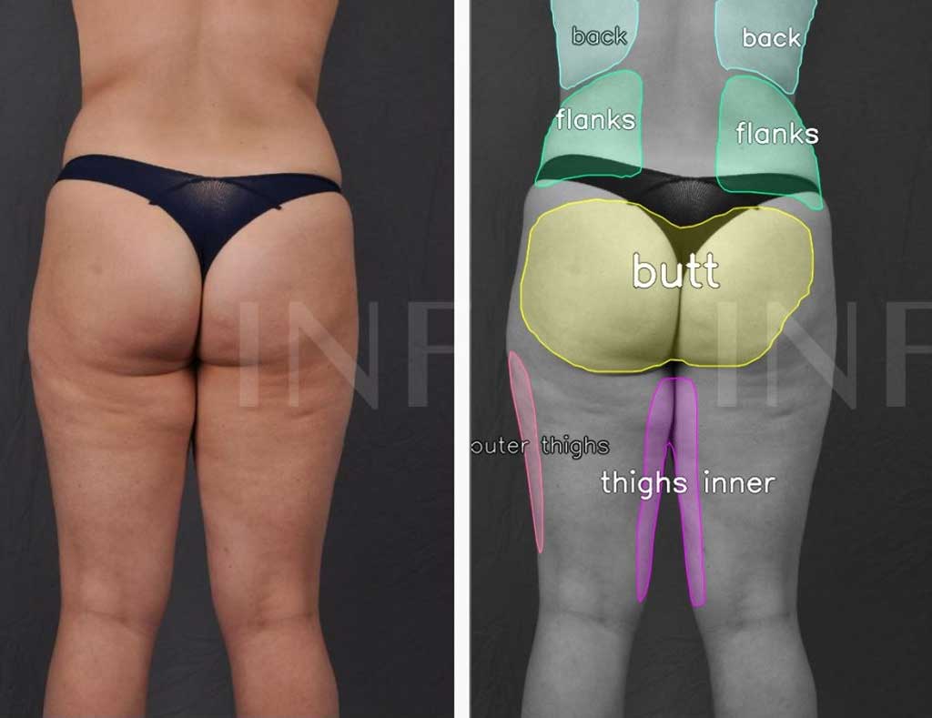 Before and After Picture - (on the left) a Back View of a Woman in her 30s - wearing a dark medical thong - (on the right) the same photo processed with AI to highlight the target liposuction areas - Bra, Flanks, Butt, Thighs