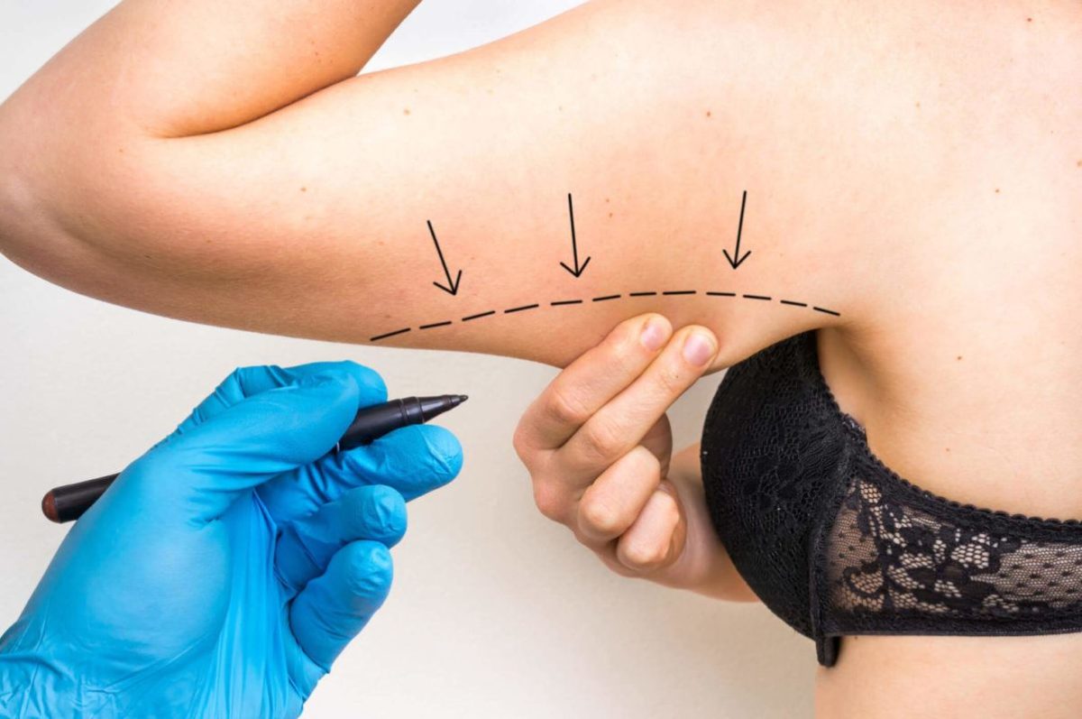 The Beauty of Precision: Liposuction for Crafting ‘The Arm of Your Dreams