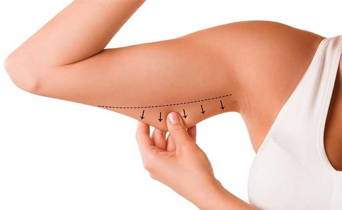 Behind the Slim: Navigating the Pain Perception of Arm Liposuction