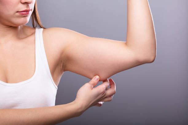 Beyond the Swelling: A Practical Approach to Arm Liposuction Recovery