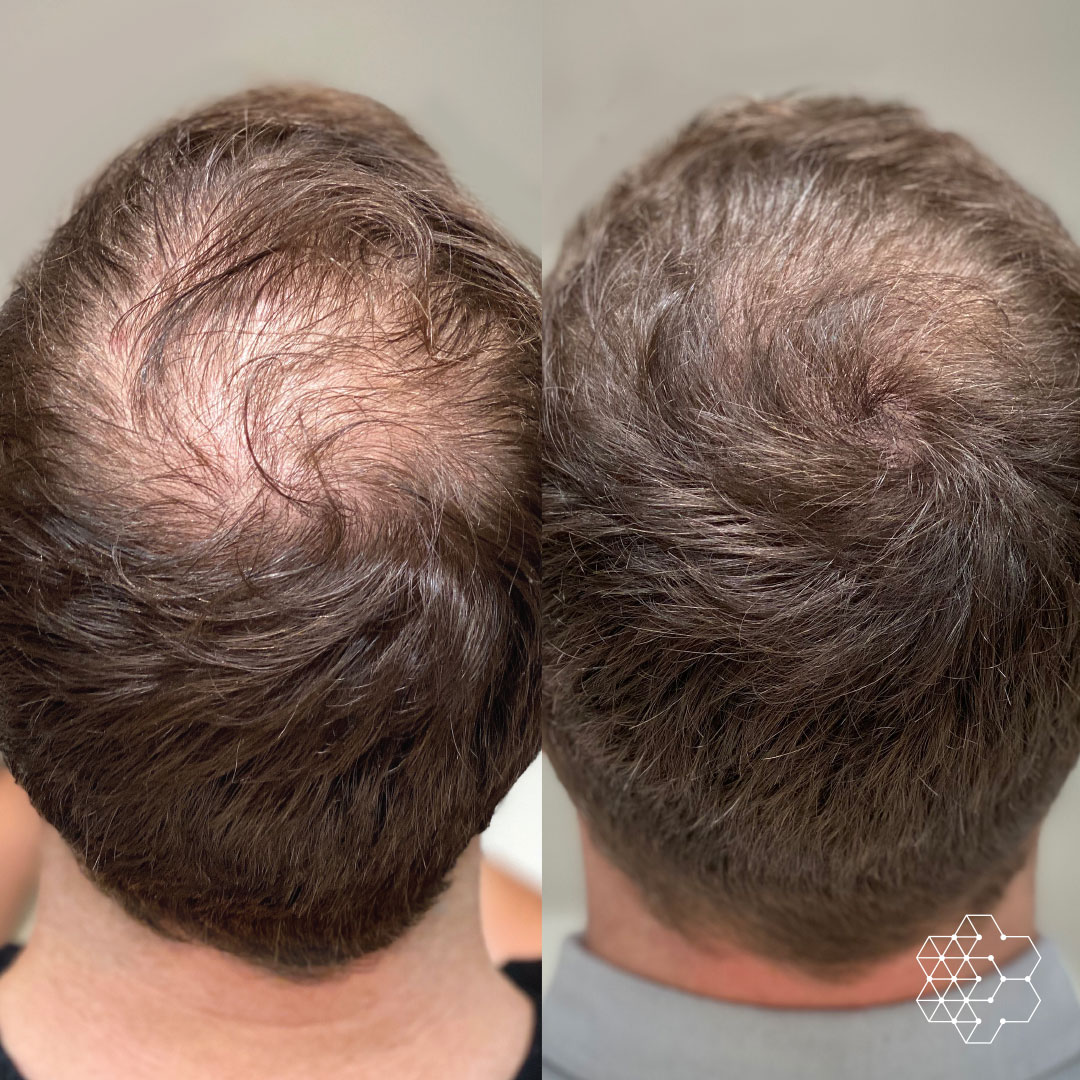 Unlocking Your Hair’s Potential: Understanding Hair Transplantation Techniques