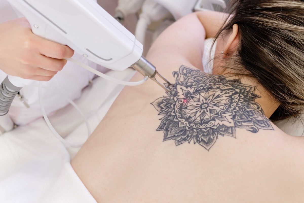 Financial Freedom from Ink: Determining Laser Tattoo Removal Costs