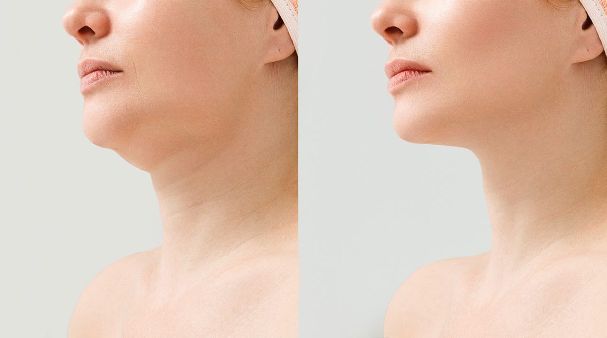 Comparing Neck Lift to Non-Surgical Options: Understanding the Nuances