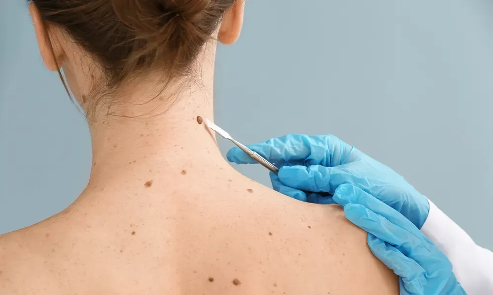 Skin Tag Removal: The Price of Confidence