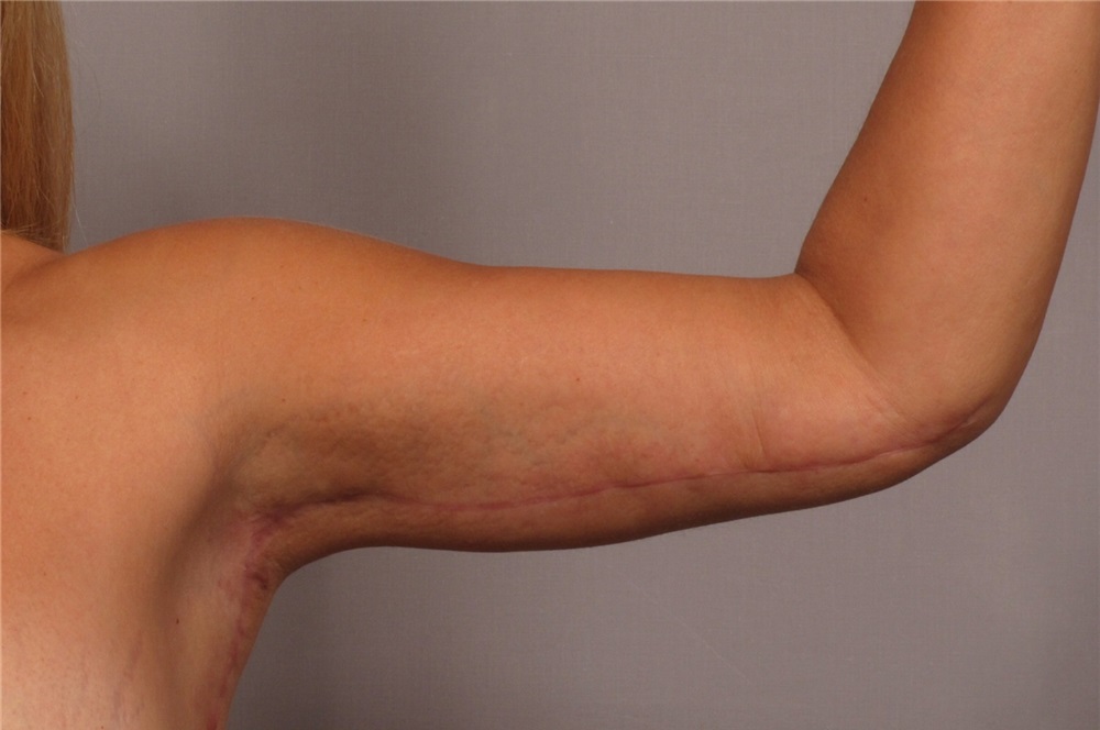 Embracing the Process: Healing Arm Lift Surgery Scars with Grace