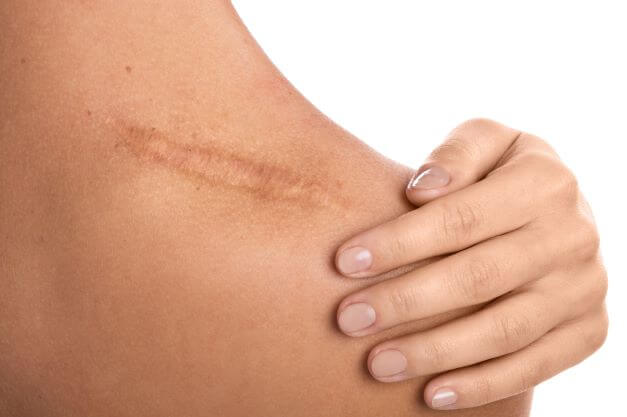 Scar Removal Surgery Covered by Insurance