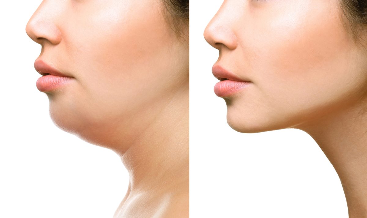 J-Plasma Under Chin Skin Tightening Guide 2026