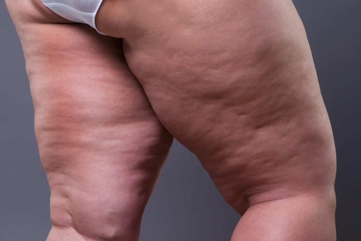 Cellulite on Legs: Understanding Causes, Risk Factors, and Prevention Strategies
