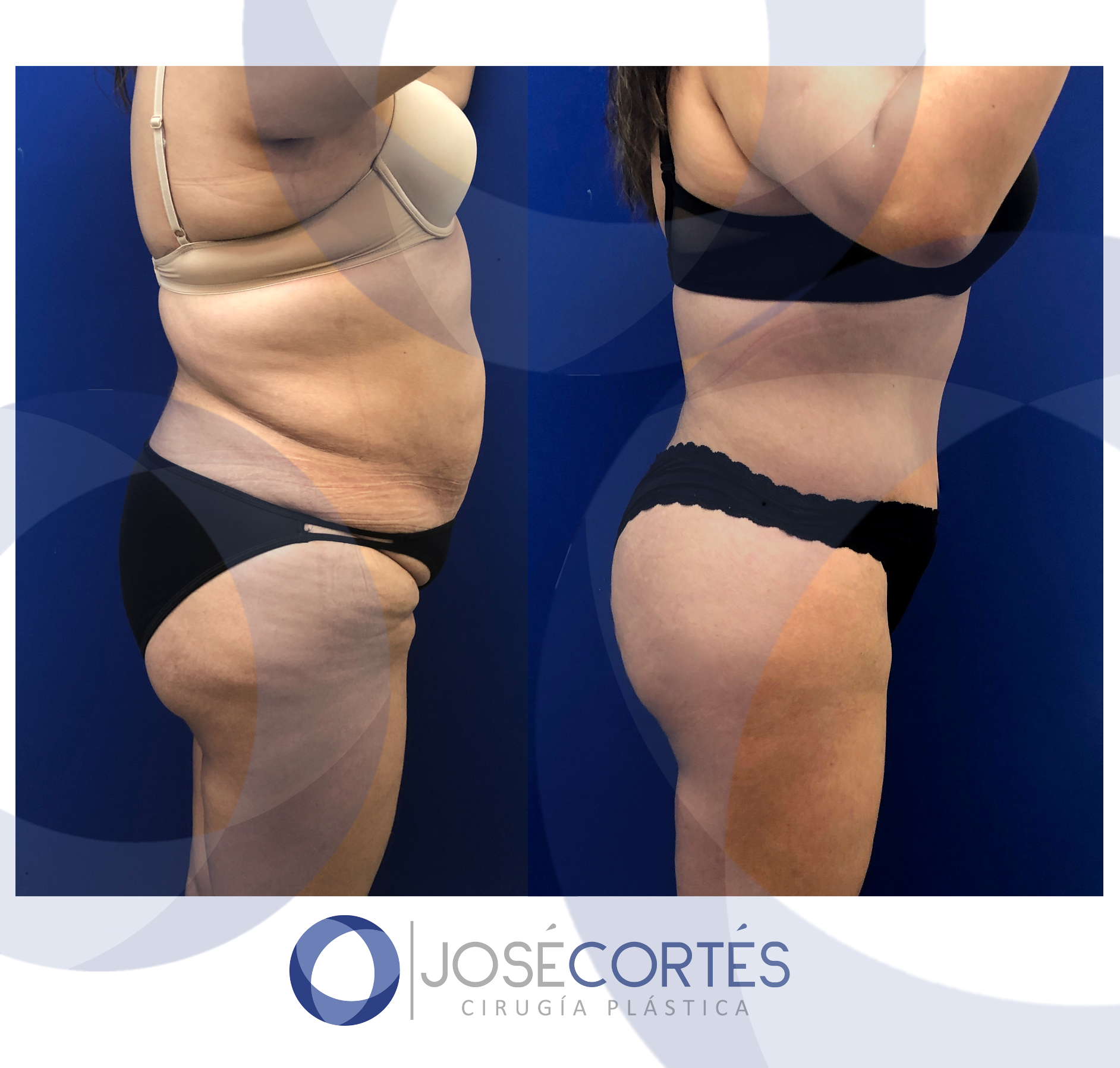 Facial Lifting - MD. José Cortés